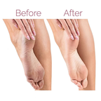 Before and after dry cracked heel transformed to smooth soft skin